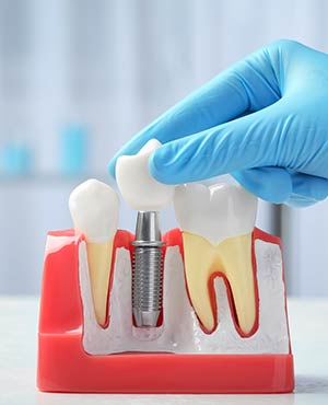 Dental Implants Specialist Near Me Serving Bay Area, San Jose, CA 