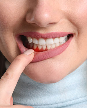 Gum Disease Treatment Near Me Serving Bay Area, San Jose, CA 