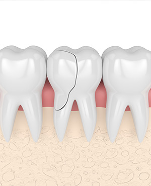Cracked Tooth Treatment Specialist Near Me Serving Bay Area, San Jose, CA 