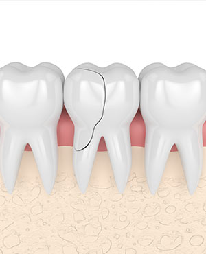 Cracked Tooth Treatment Specialist Near Me Serving Bay Area, San Jose, CA 