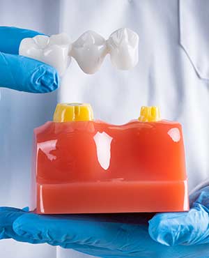 Dental Bridges Near Me Serving Bay Area, San Jose, CA 