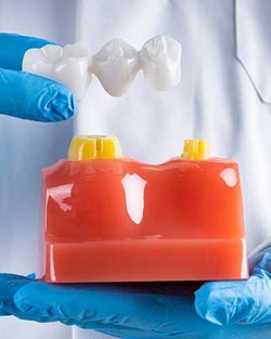 Dental Bridges Near Me Serving Bay Area, San Jose, CA