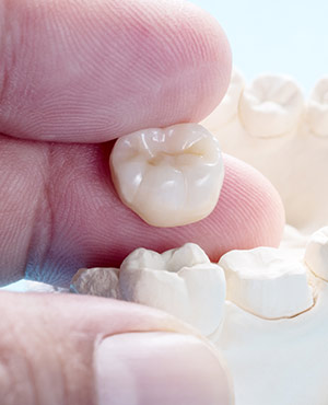 Dental Crowns Near Me Serving Bay Area, San Jose, CA 