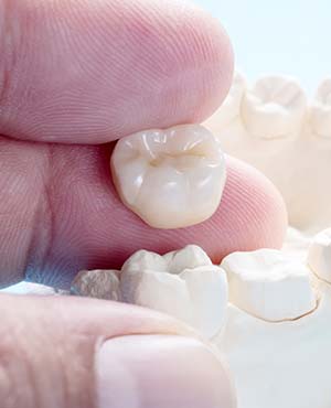 Dental Crowns Near Me Serving Bay Area, San Jose, CA 