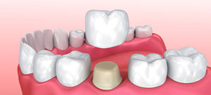 Types of Dental Crowns Near Me Serving Bay Area, San Jose, CA Types of Dental Crowns Near Me Serving Bay Area, San Jose, CA
