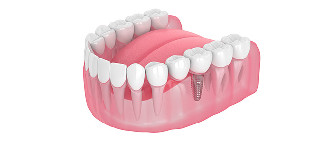 What Are the Most Common Issues With Dental Bridges? | Selective Dental Serving Bay Area San Jose CA What Are the Most Common Issues With Dental Bridges? | Selective Dental Serving Bay Area San Jose CA