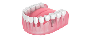What Are the Most Common Issues With Dental Bridges? | Selective Dental Serving Bay Area San Jose CA What Are the Most Common Issues With Dental Bridges? | Selective Dental Serving Bay Area San Jose CA
