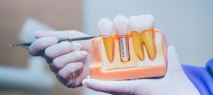 Dental Implant Crowns Serving Bay Area, San Jose, CA Dental Implant Crowns Serving Bay Area, San Jose, CA