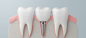 Where Can I Get Affordable Dental Implants Near Me in San Jose, CA
