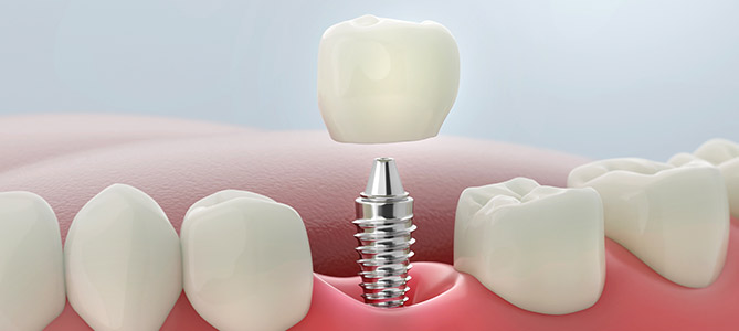 Single Tooth Implant Dentist Serving Bay Area, San Jose, CA