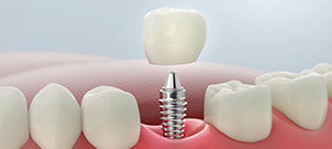 Single Tooth Implant Dentist Serving Bay Area, San Jose, CA