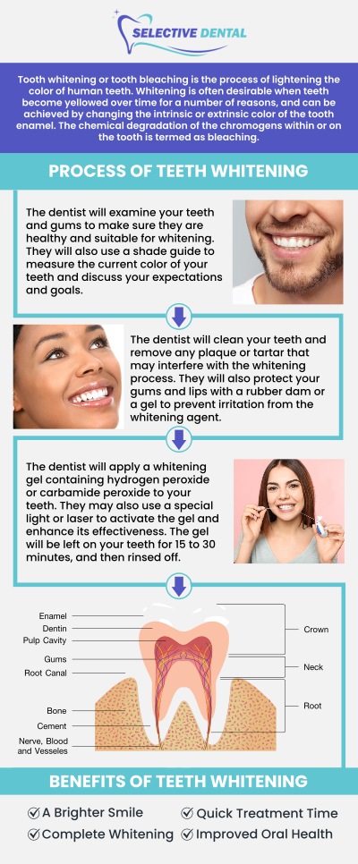 Teeth whitening is a safe way to achieve a brighter smile. We help lift stains & improve your tooth color so your smile looks whiter, brighter & healthier. Brightening your smile with our teeth whitening treatment offered by an experienced dentist at Selective Dental. For more information, contact us today or schedule an appointment online. We are conveniently located at 3151 South White Road, Suite 203 San Jose, CA 95148. Teeth whitening is a safe way to achieve a brighter smile. We help lift stains & improve your tooth color so your smile looks whiter, brighter & healthier. Brightening your smile with our teeth whitening treatment offered by an experienced dentist at Selective Dental. For more information, contact us today or schedule an appointment online. We are conveniently located at 3151 South White Road, Suite 203 San Jose, CA 95148.